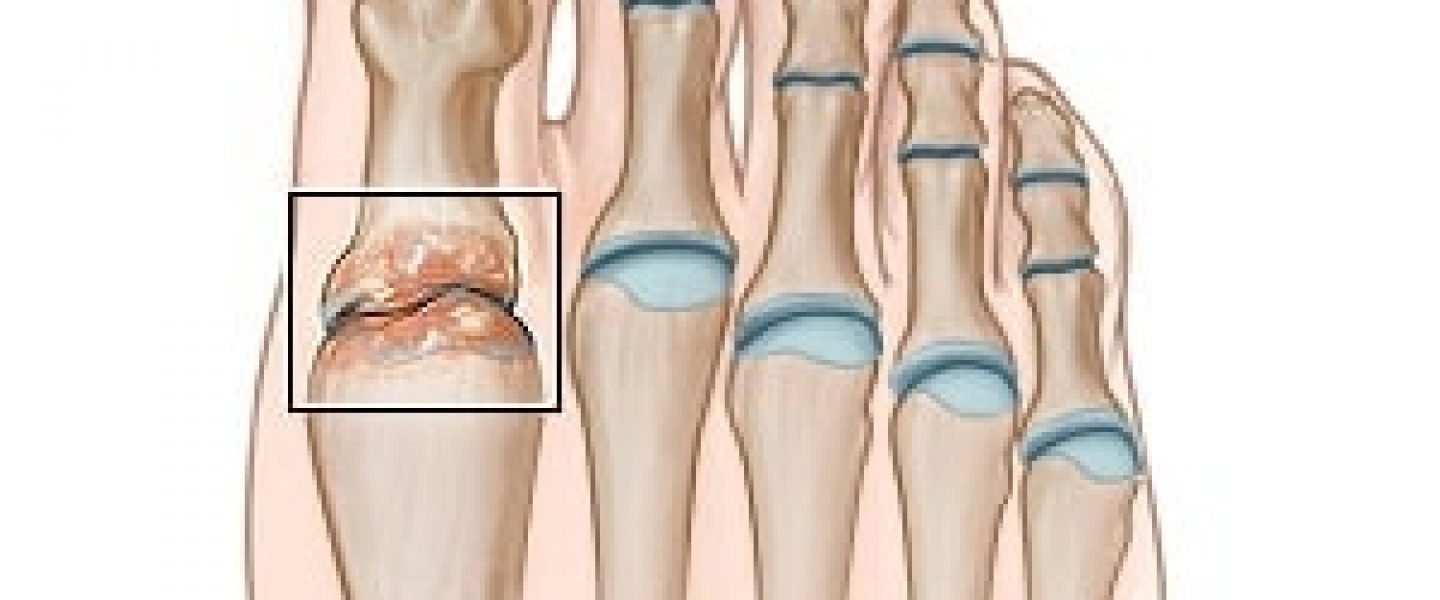 osteoarthritis cartilidge breakdown